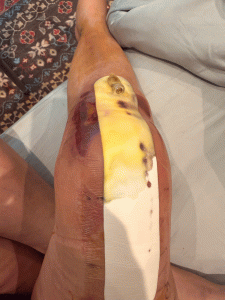 after surgery knee