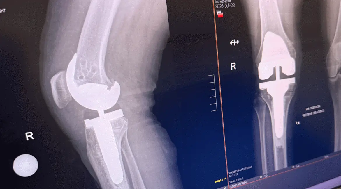 xray of knee