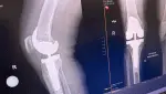 xray of knee