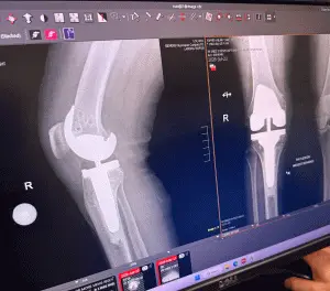 xray of knee